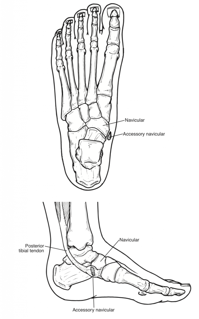 Accessory Navicular Syndrome San Mateo Podiatry Group
