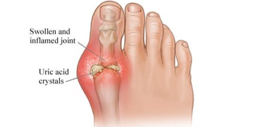 Gout is a disorder that results from the buildup of uric acid in the tissues or a joint. It most often affects the joint of the big toe.