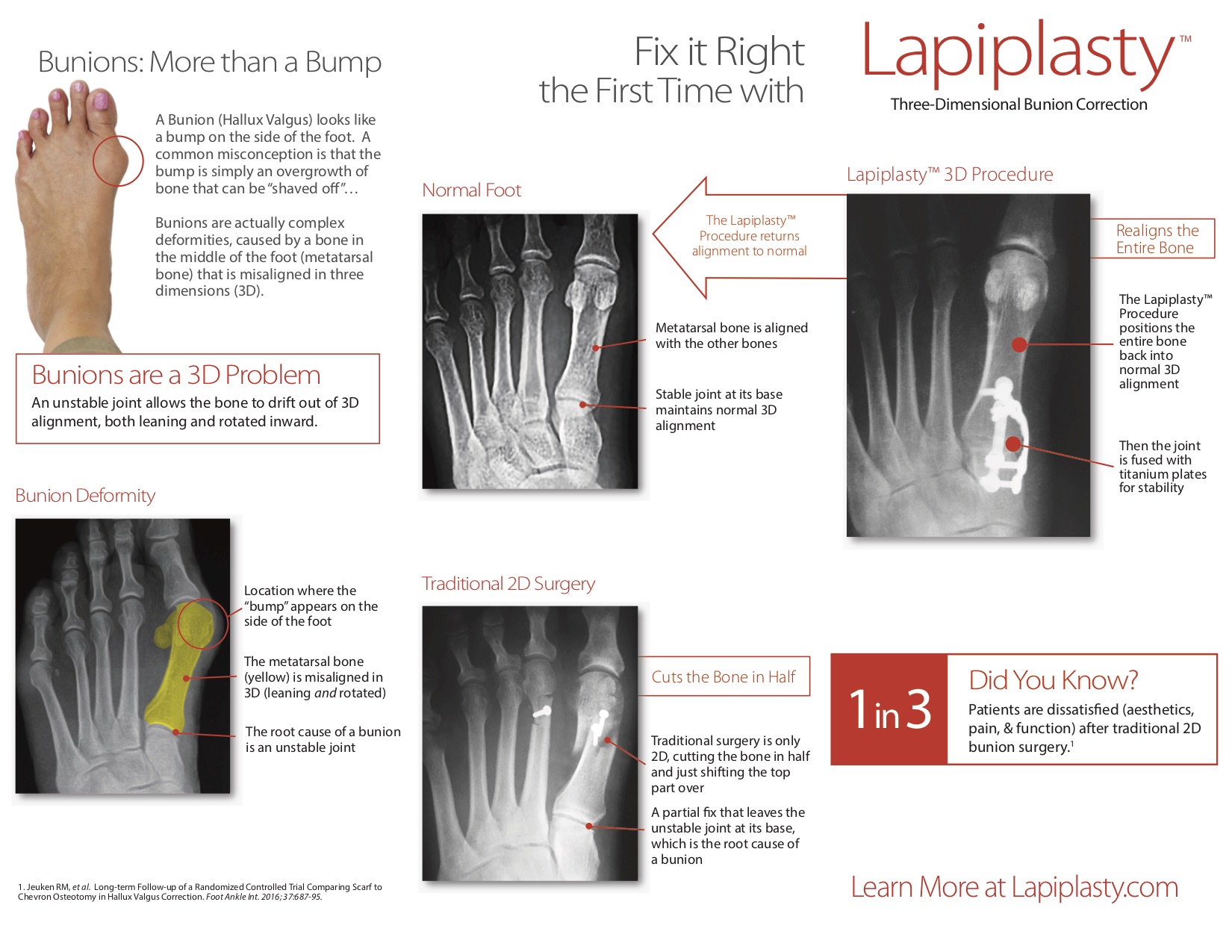 Lapiplasty® State of the Art Bunion Surgery Dr. Bill J. Metaxas