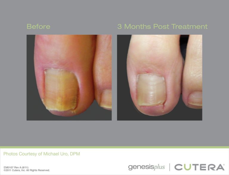 Toenail Fungus Toenail Fungus Laser Treatment Toe Fungus Treatment