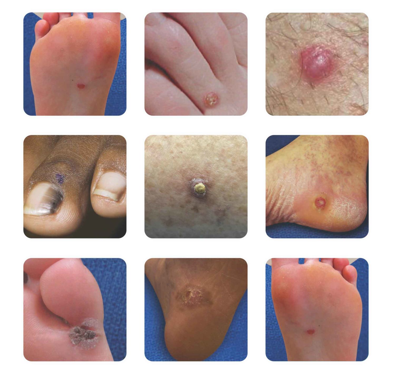 Foot Biopsy Skin Biopsy on Feet Foot Skin Cancer